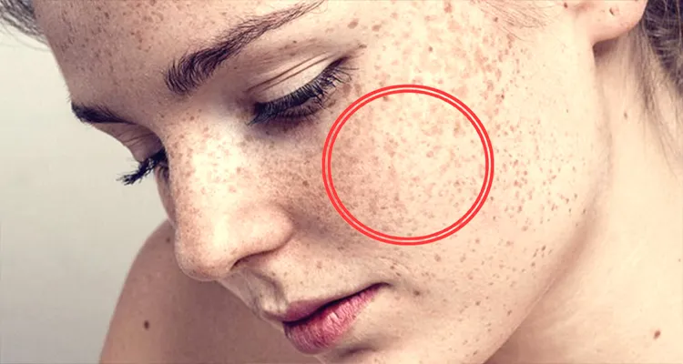 Gebelikte Cilt Lekeleri